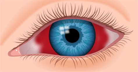 Eye bleeding: Types, causes, treatment, and seeking。